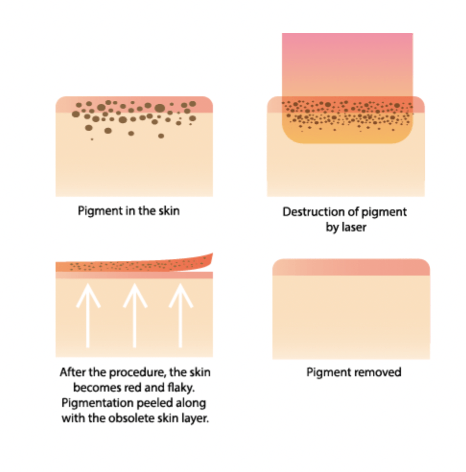 Laser Skin Pigmentation in Hyderabad