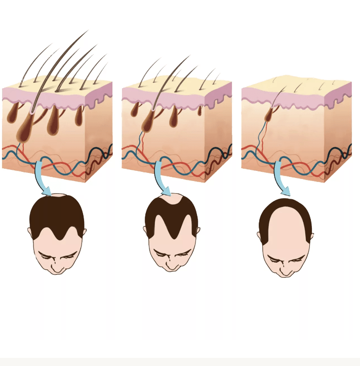 Hair Loss Treatment in Hyderabad