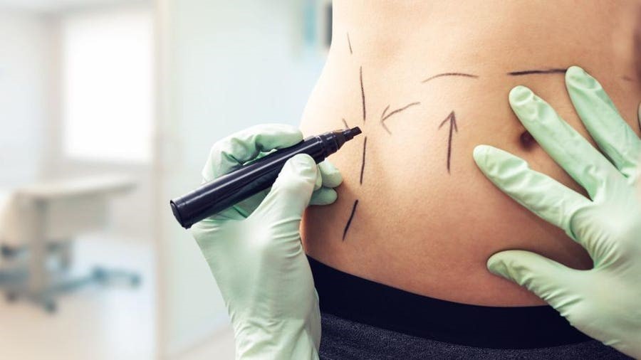 Laser Liposuction in Hyderabad
