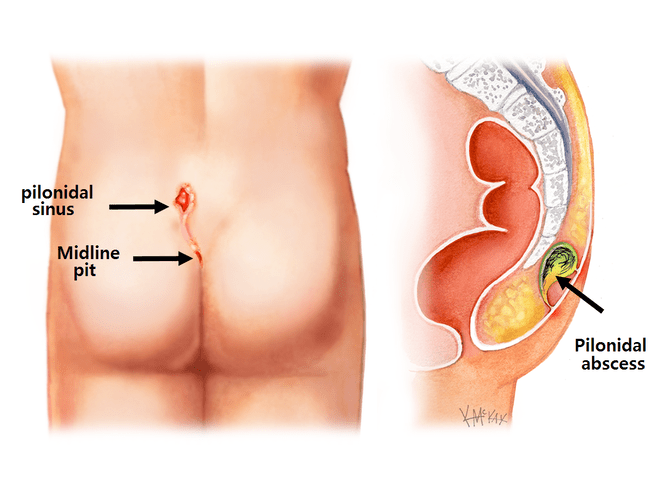 Pilonidal Sinus