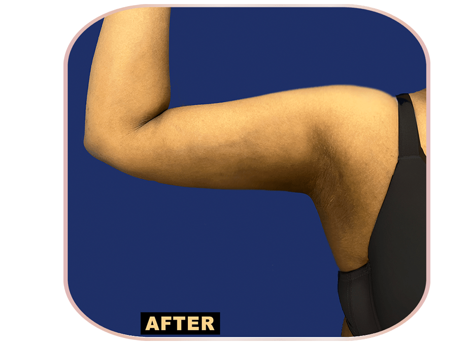 ARM After