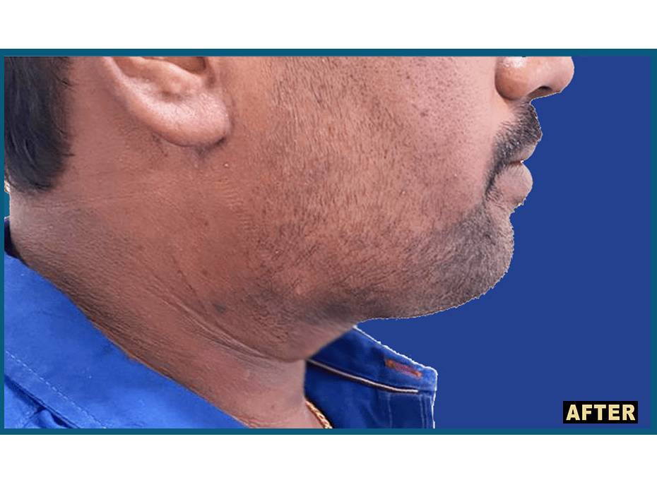 Double Chin