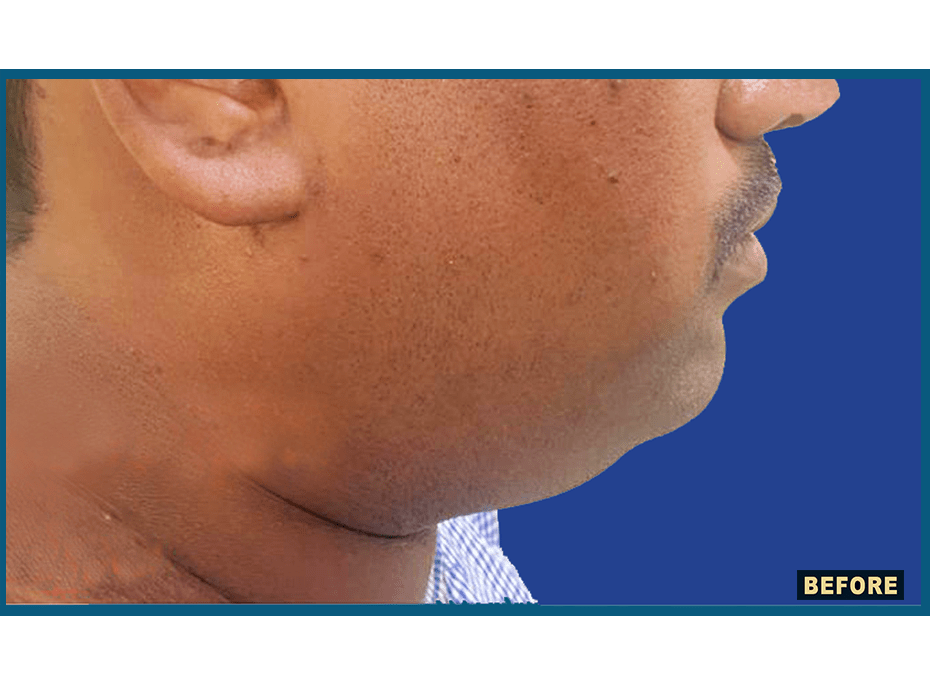 Double Chin Before