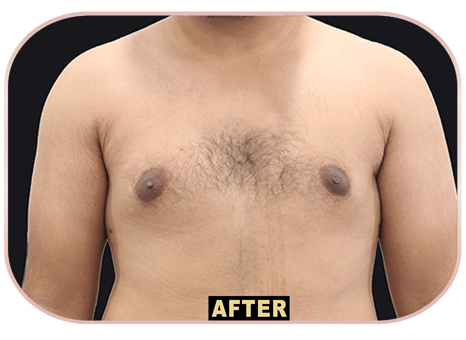 Gynecomastia AFTER