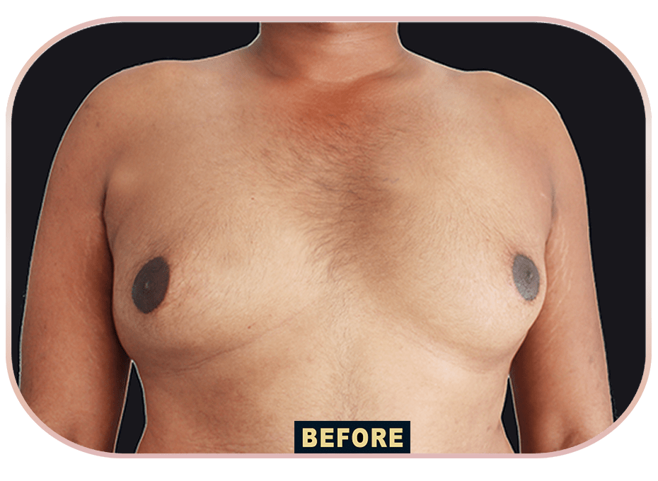 Gynecomastia
