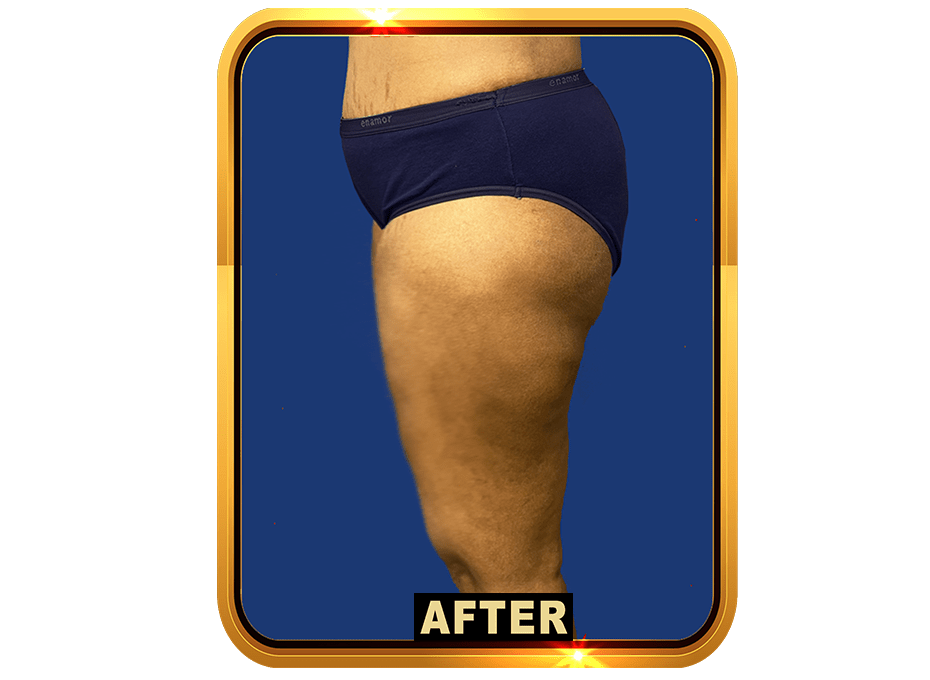 Thigh After