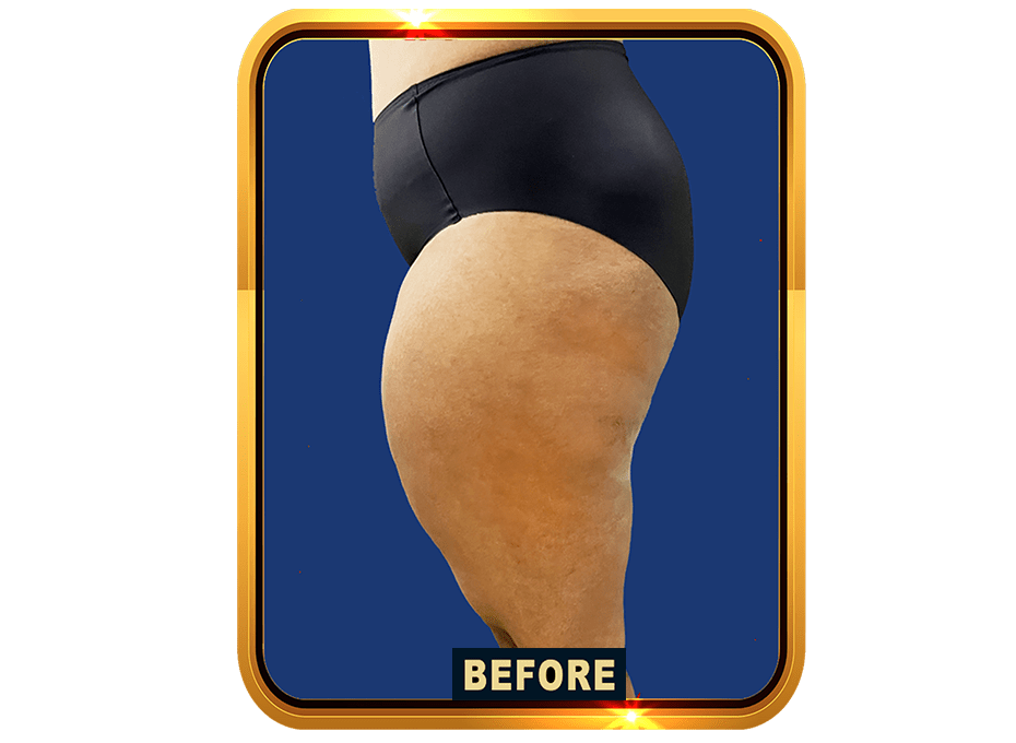 Thigh Before