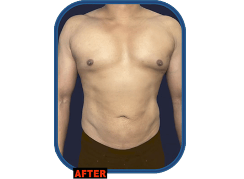 HD Liposuction Hyderabad HD Liposuction Hyderabad
