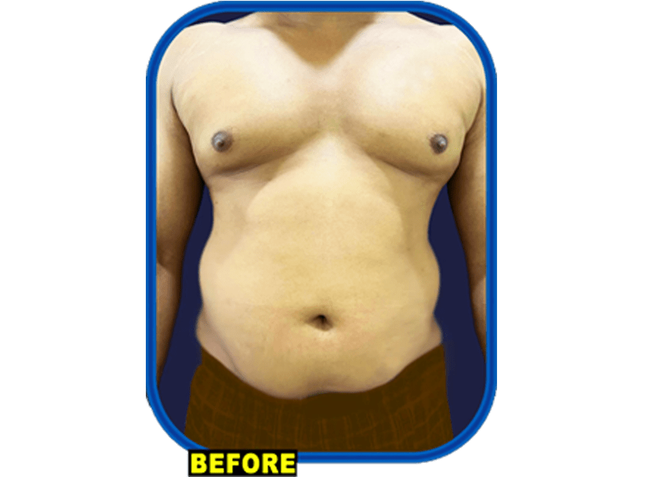 HD Liposuction Hyderabad HD Liposuction Hyderabad