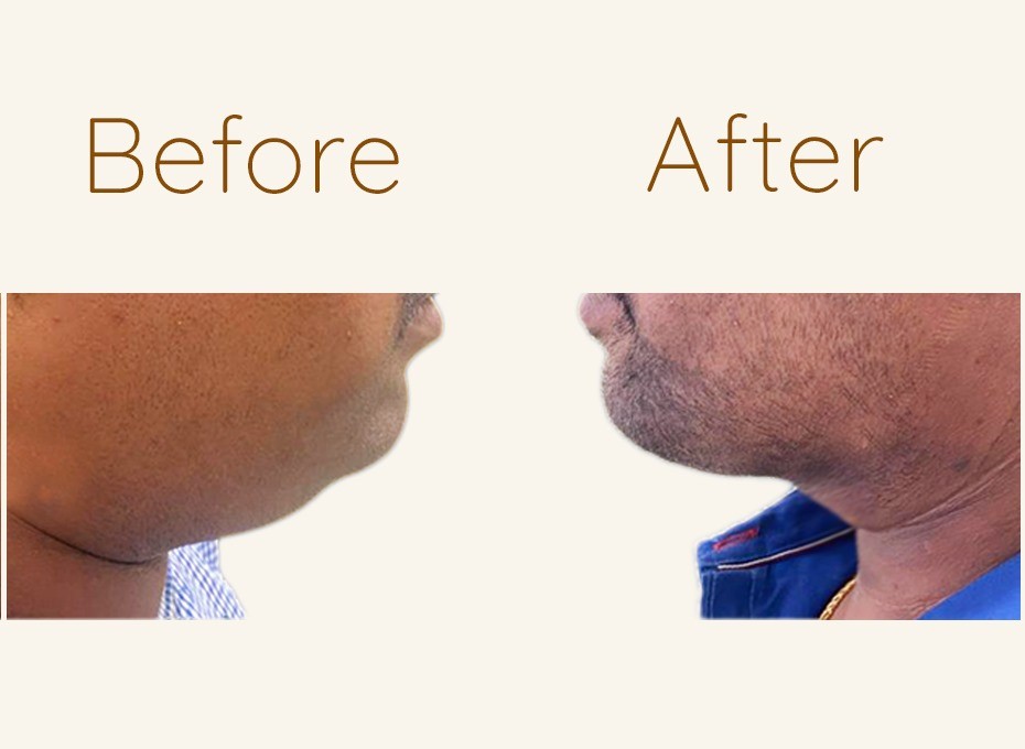 Double Chin Before and After