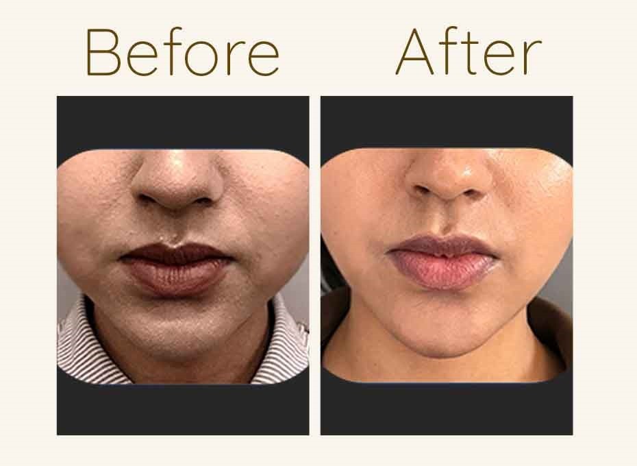 Buccal Fat removal in Hyderabad