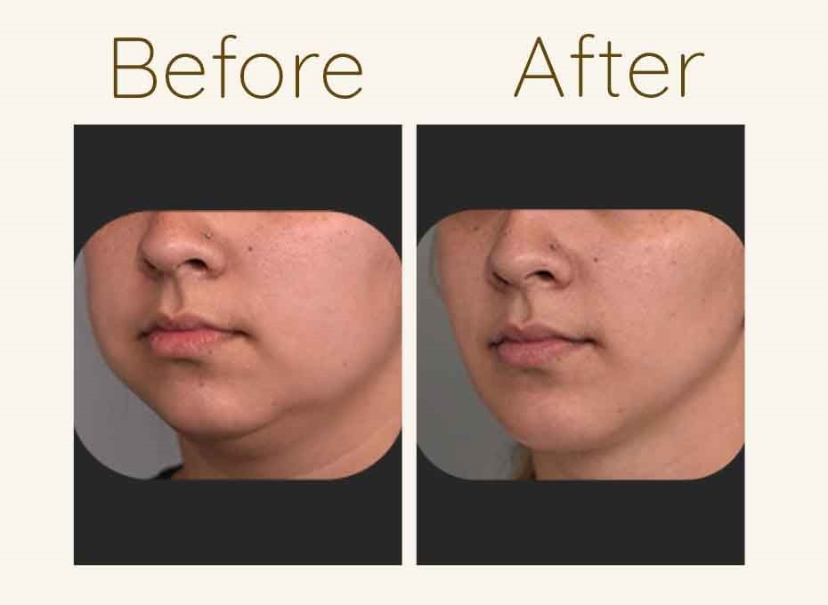 Buccal Fat removal