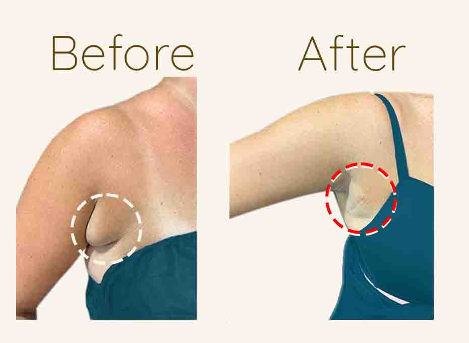 Axillary Breast in hyderabad