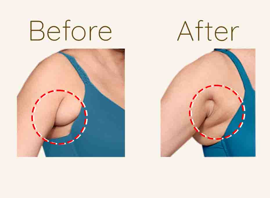 Axillary Breast in hyderabad