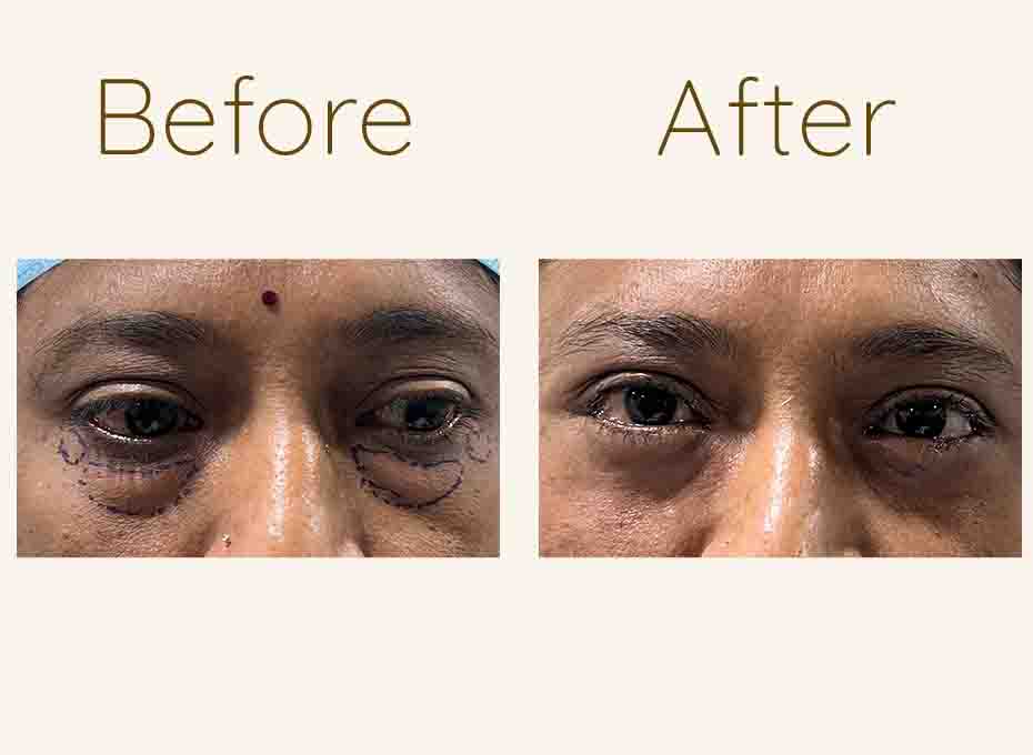Eyelid Surgery in Hyderabad