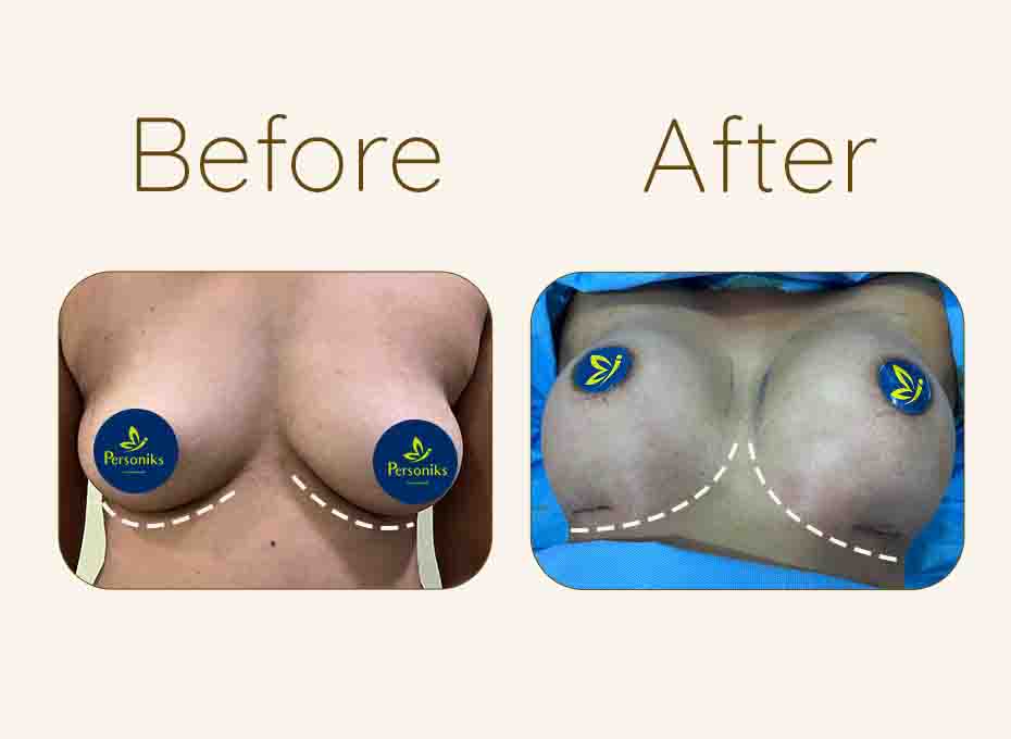 Breast Augmentation in hyderabad
