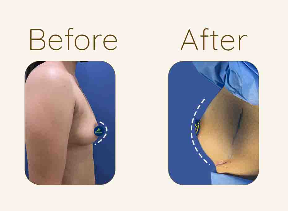Breast Augmentation in hyderabad