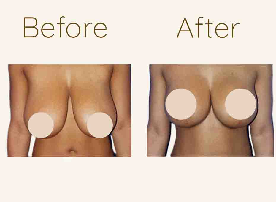 Breast lift