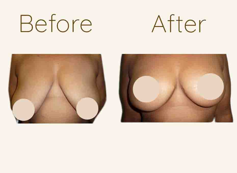 Breast lift