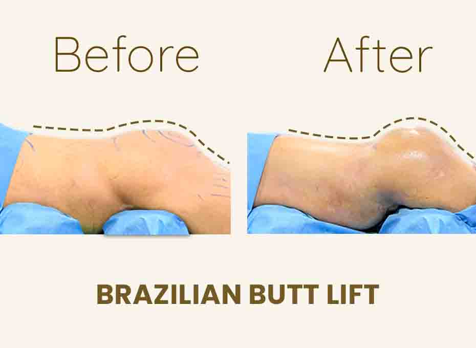 Butt liposuction
