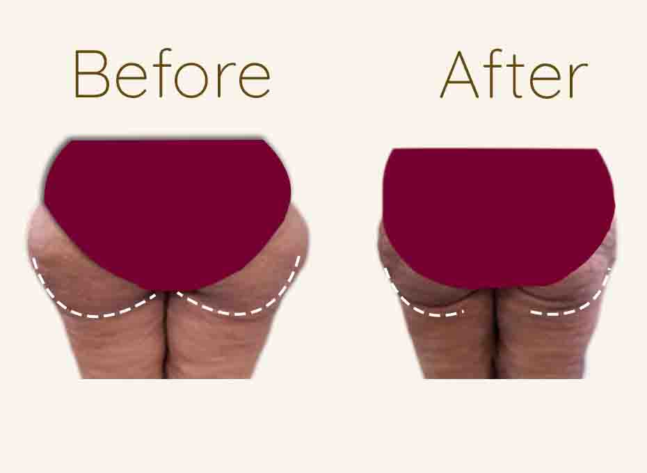 Butt liposuction