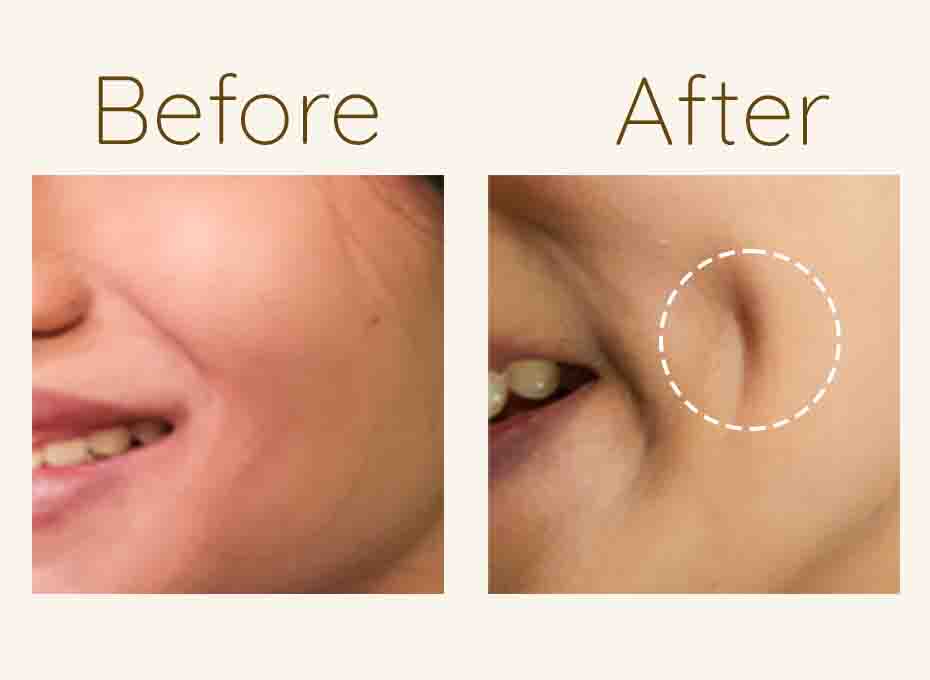 Dimple creation in hyderabad