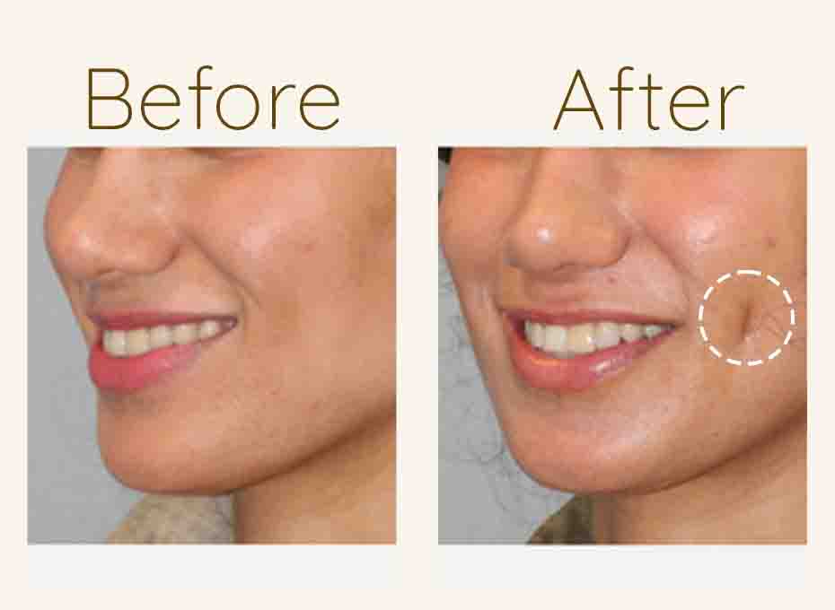 Dimple creation in hyderabad