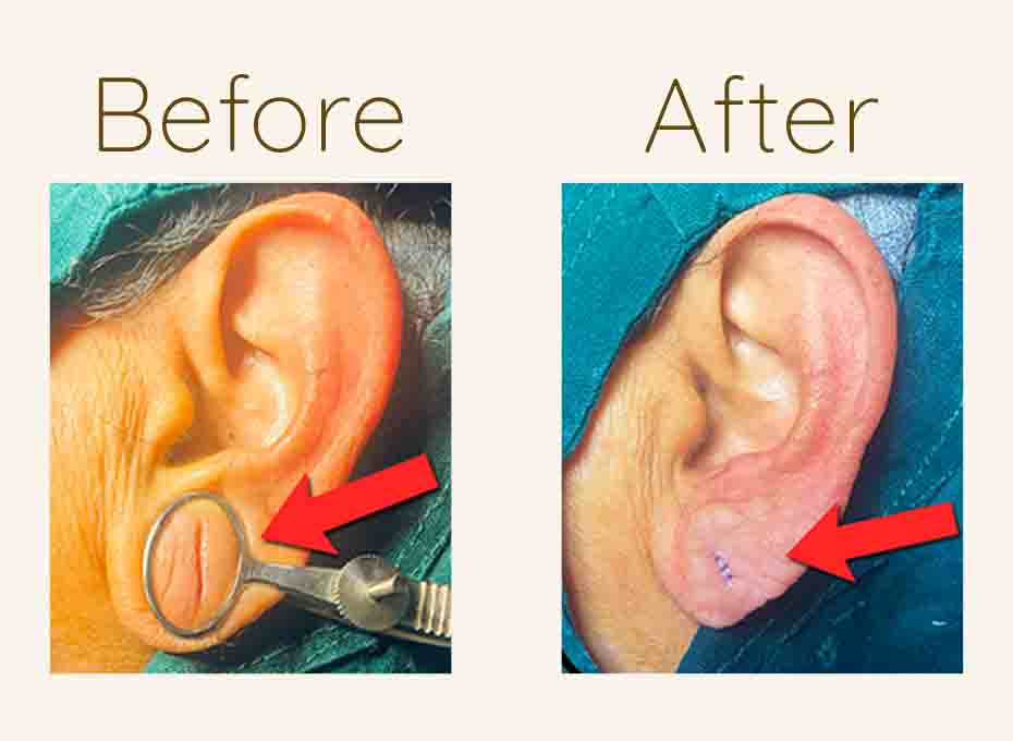 Ear Lobe Repair
