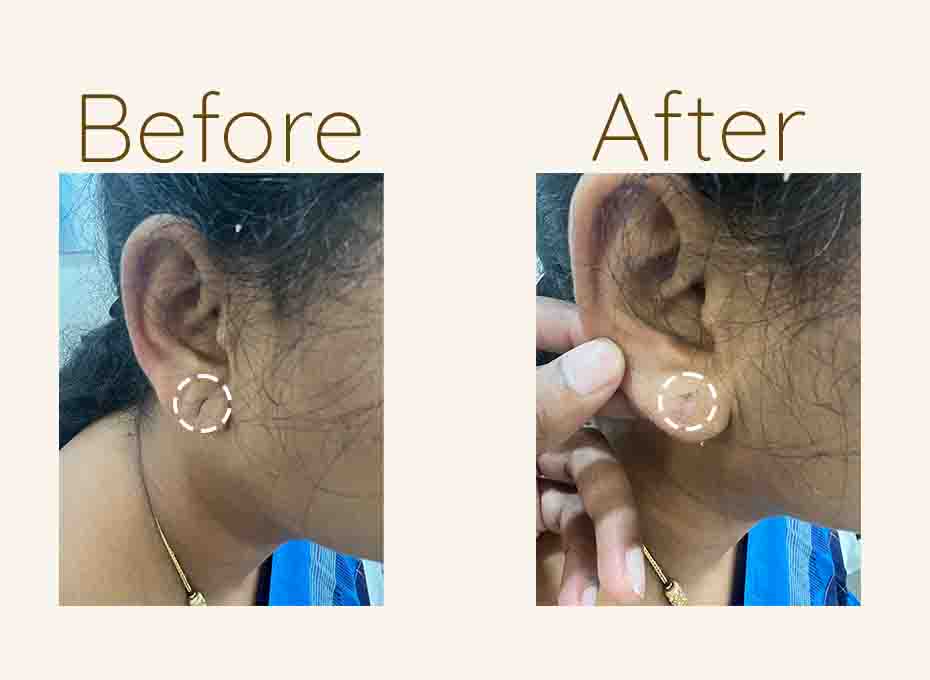 Ear Lobe Repair
