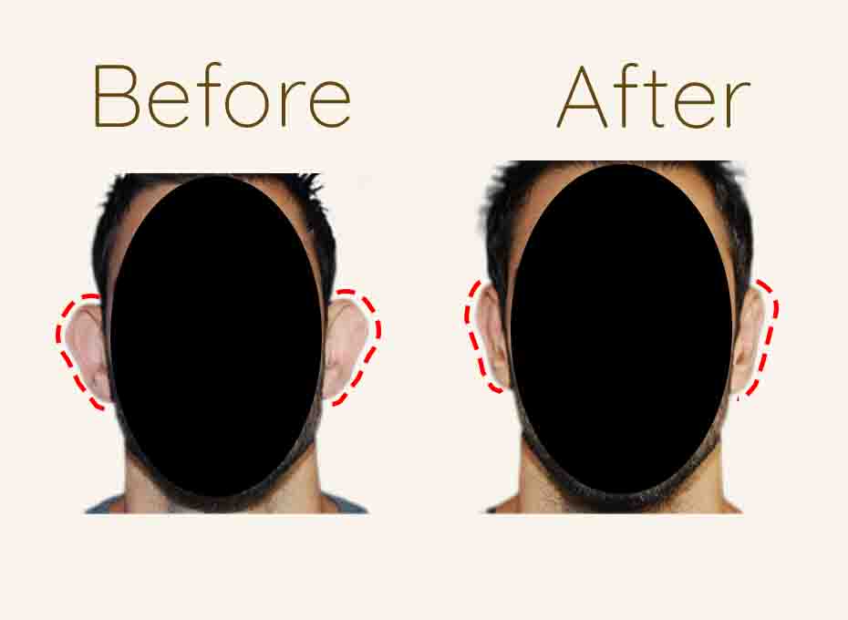 Ear Shaping in hyderabad