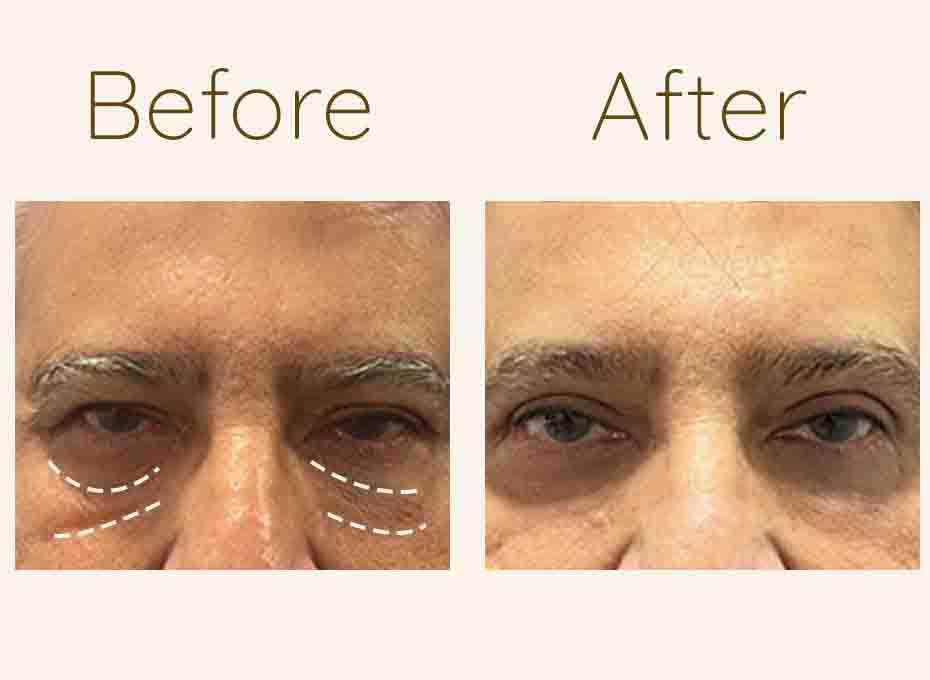 Eyelid Surgery in Hyderabad