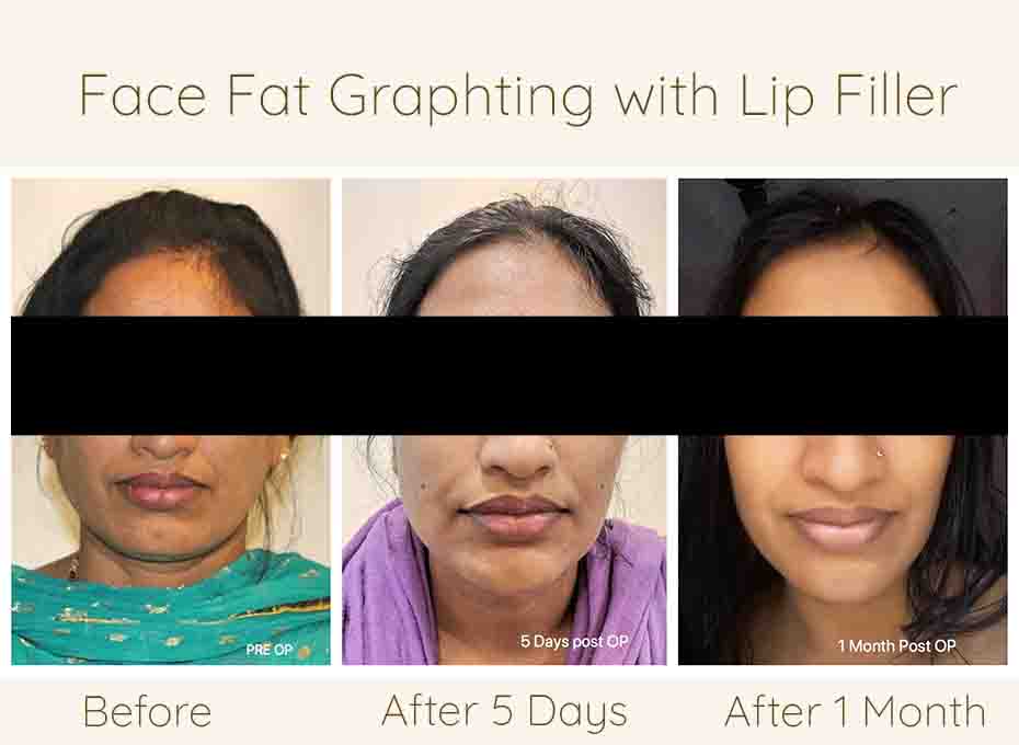 Face Fat removal in hyderabad
