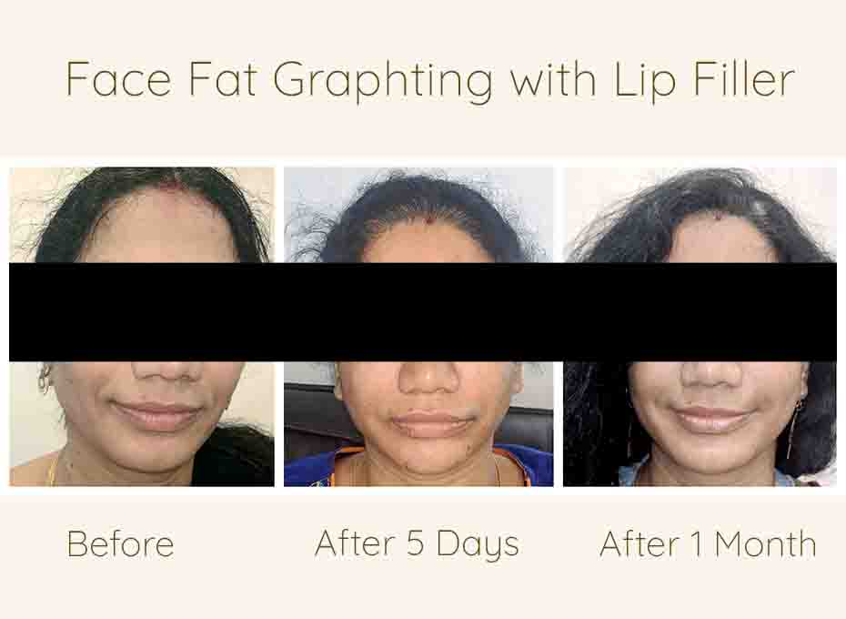 Face Fat removal in hyderabad