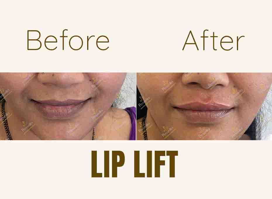 Lip Correction in hyderabad
