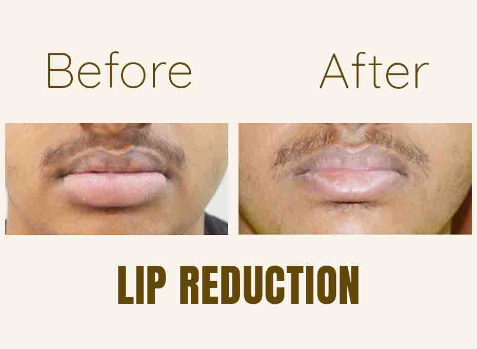 Lip Correction in hyderabad