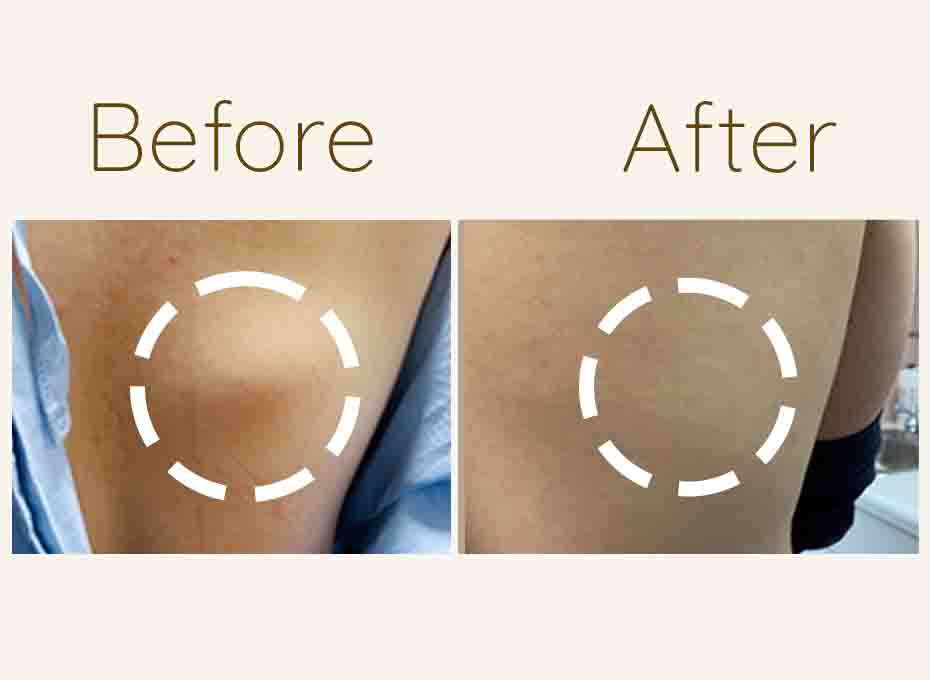 Lipoma Removal