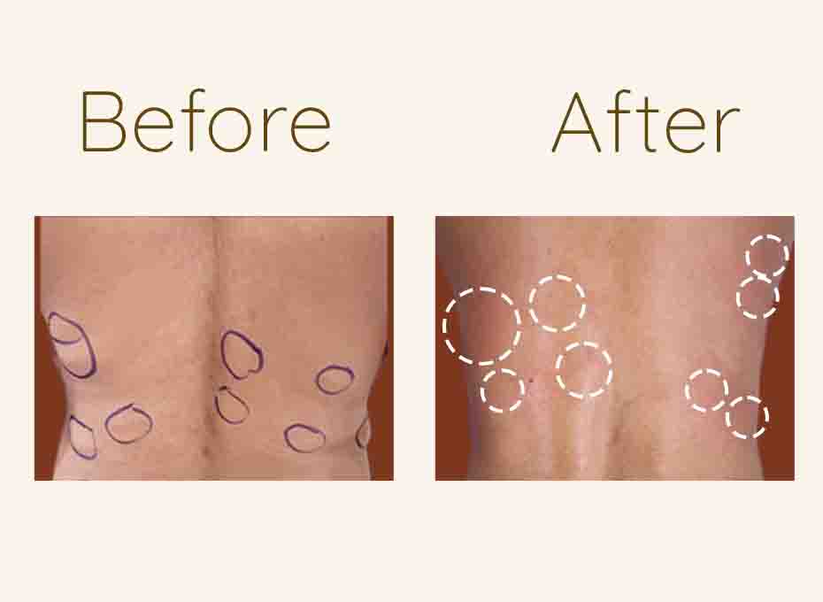 Lipoma Removal