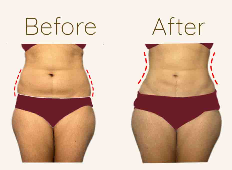 Liposuction Before and After