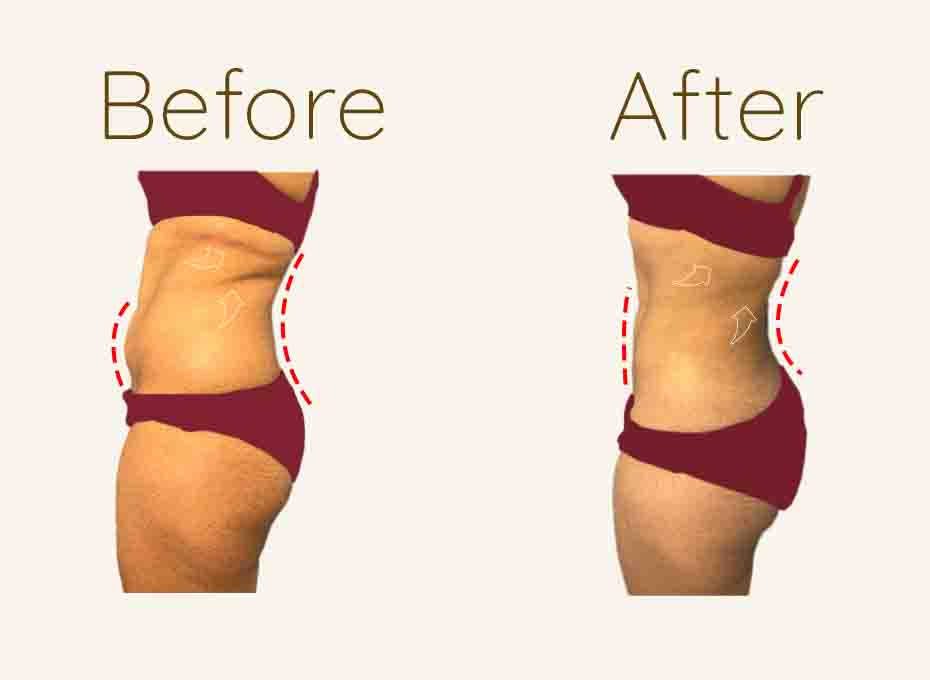 Liposuction Before and After
