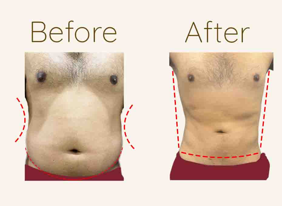 Liposuction Before and After
