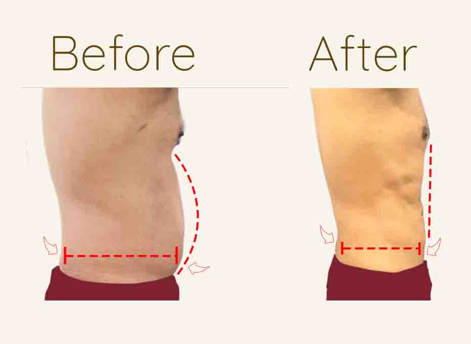 Liposuction Before and After
