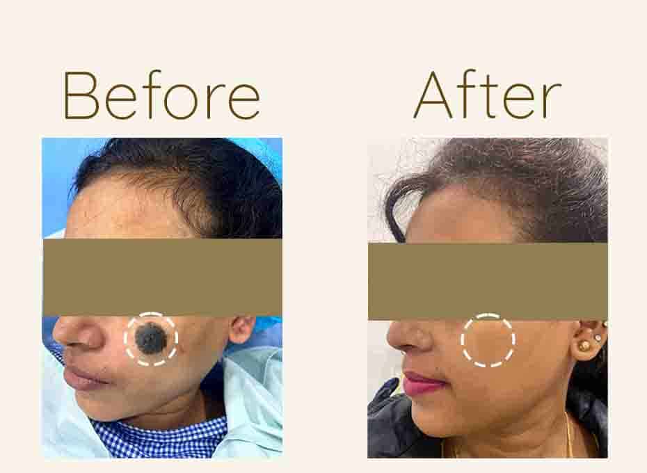 Mole Removal