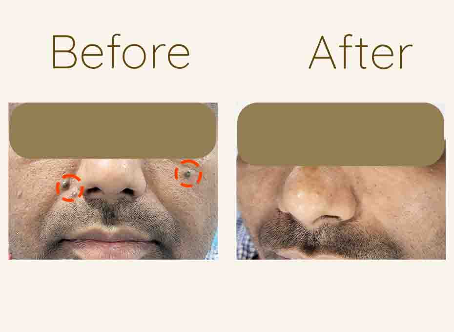 Mole Removal