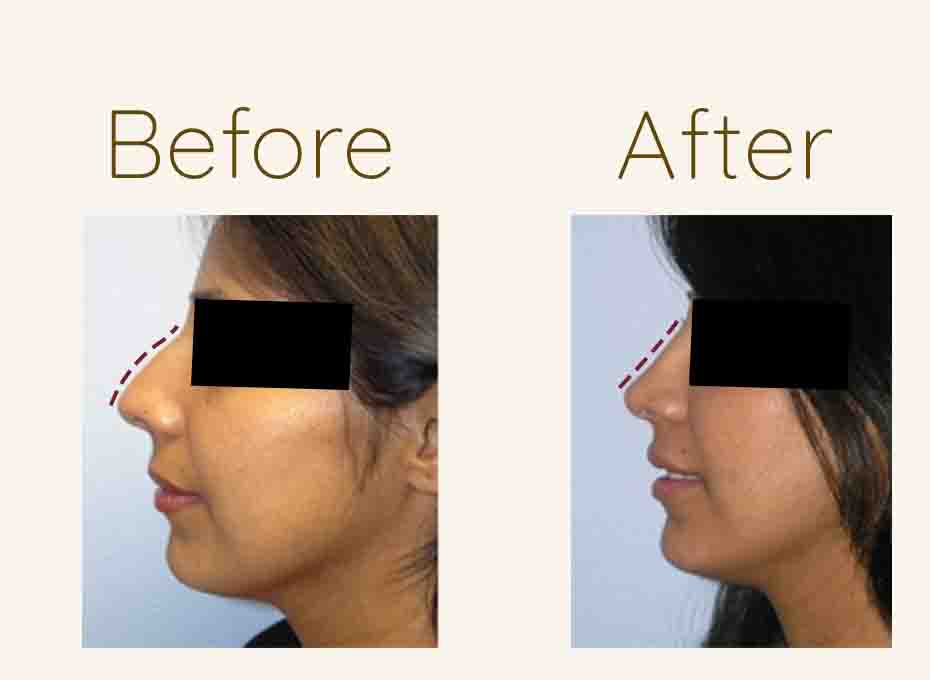 Nose Shaping in Hyderabad