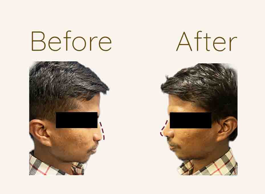 Nose Shaping in Hyderabad