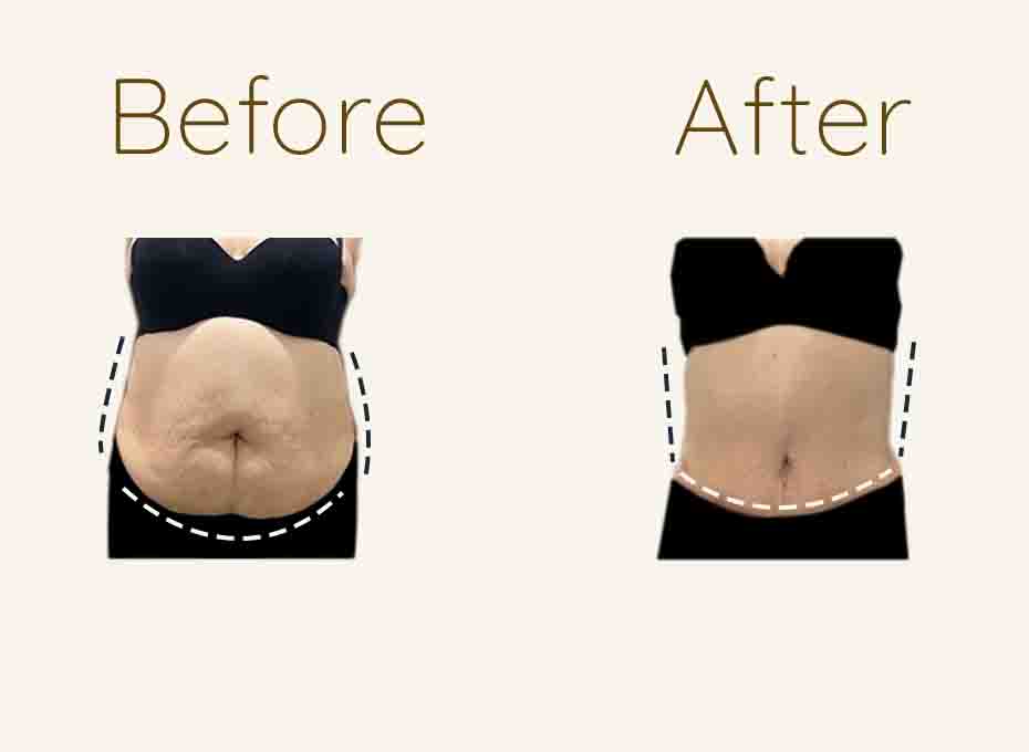 Tummy Tuck Before and After