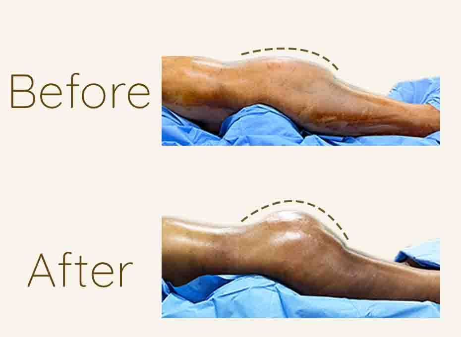 Butt lift and Hips Liposuction in Hyderabad