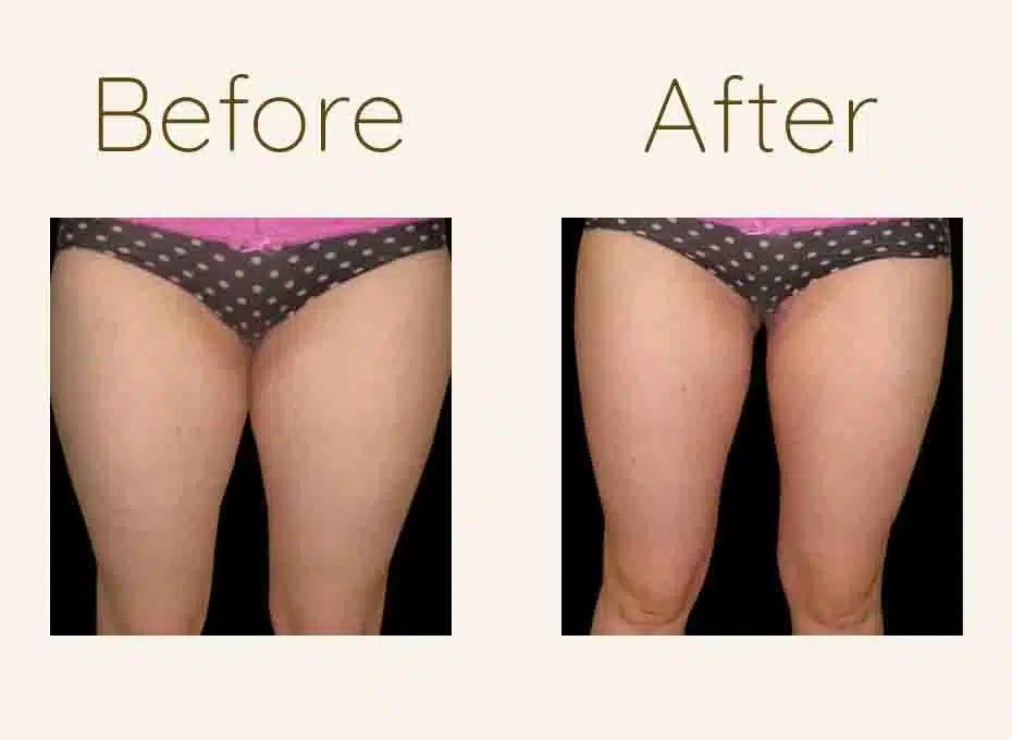 Thigh and Calf Liposuction