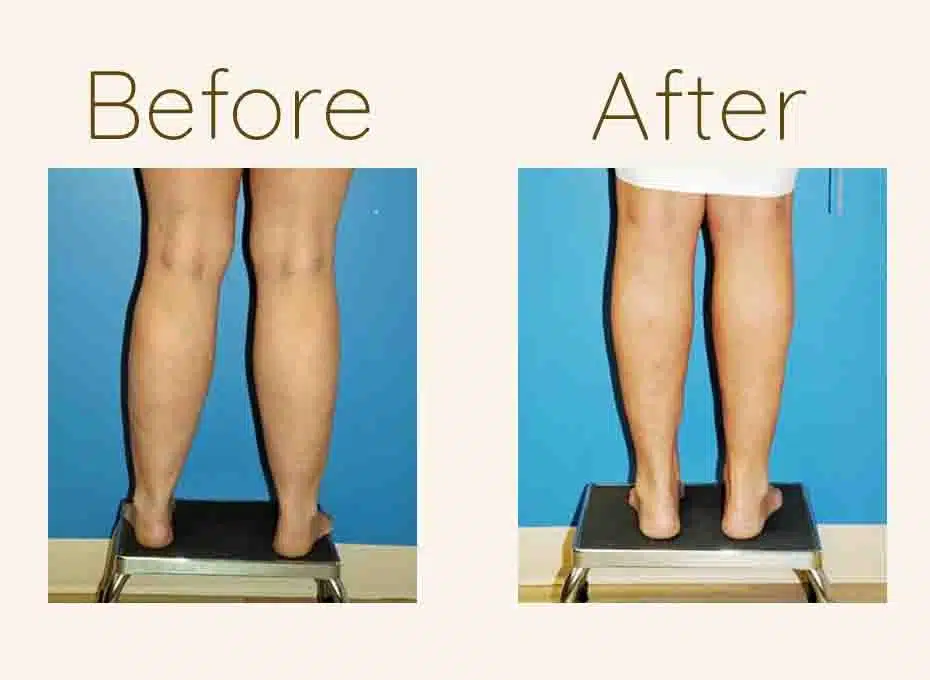 Thigh and Calf Liposuction
