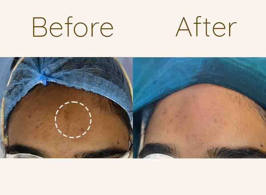 acne scar